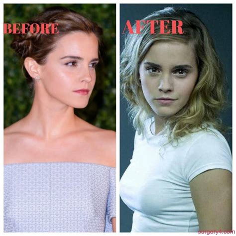 did emma watson get a boob job